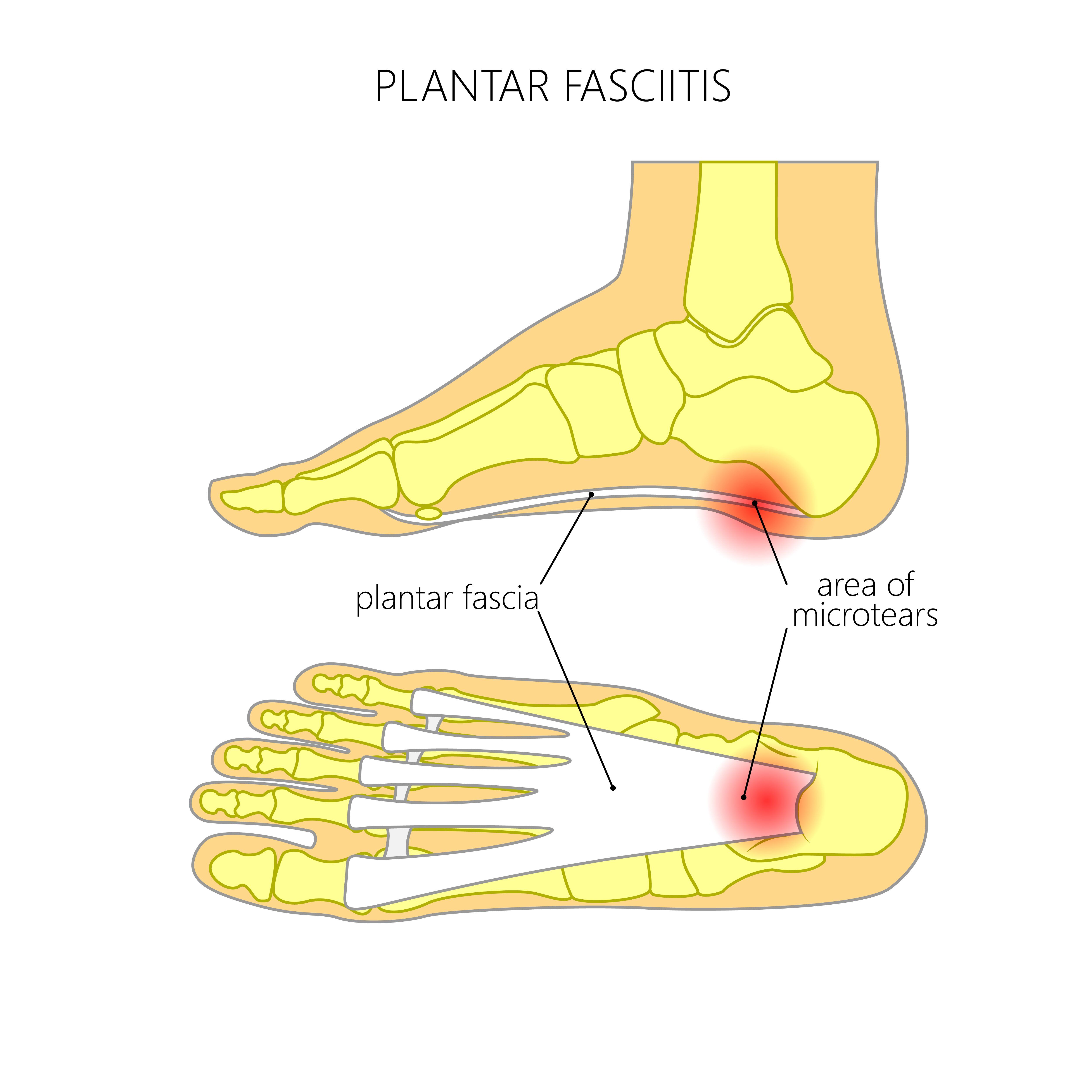 Plantar fasciitis - what causes it and how to manage it?